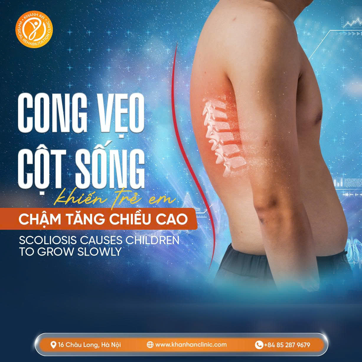 Những Dấu Hiệu Cong Vẹo Cột Sống Ở Trẻ Mà Cha Mẹ Không Thể Bỏ Qua